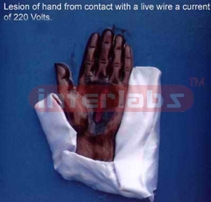 Electrocution - Electric entry mark on hand